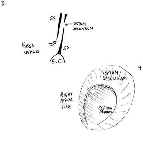 PFO Defect 的图像结果