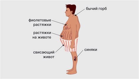 Синдром Иценко-Кушинга (гиперкортицизм) - причины и симптомы