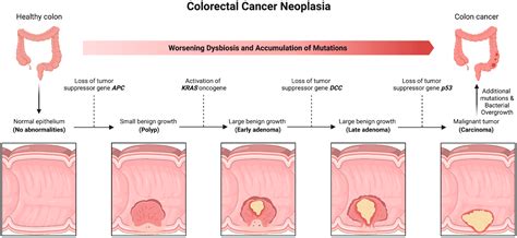 Bacterial Involvement in Progression and Metastasis of Colorectal Neoplasia