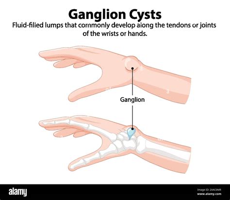 Illustration of ganglion cysts on wrist and hand Stock Vector Image & Art - Alamy