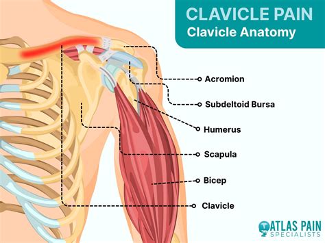 What Causes Clavicle Pain - Atlas Pain Specialists
