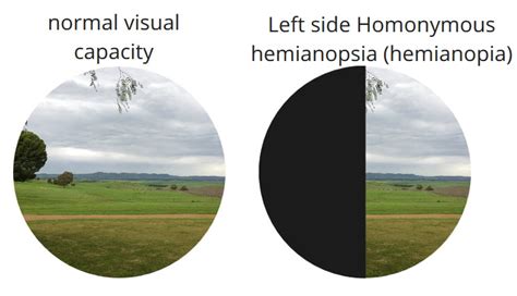 Image result for Contralateral Homonymous Hemianopsia
