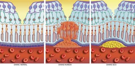 Dry Macular Degeneration -Dry AMD symptoms, treatment, and progression