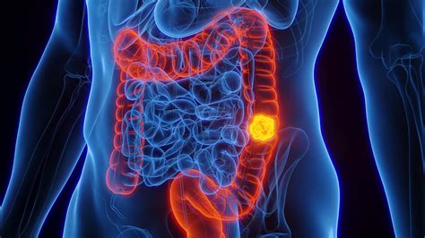 Overall, Progression-Free Survival in Colon Cancer Indicated Through ...