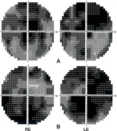 Image result for Visual Field Chart