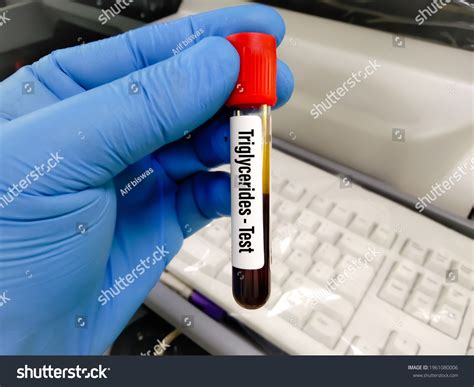 Blood Sample Tube Triglyceride Test Medical Stock Photo 1961080006 | Shutterstock