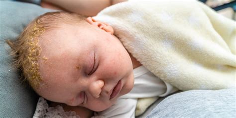 Cradle Cap Explained: The True Causes, Treatments & What to Avoid