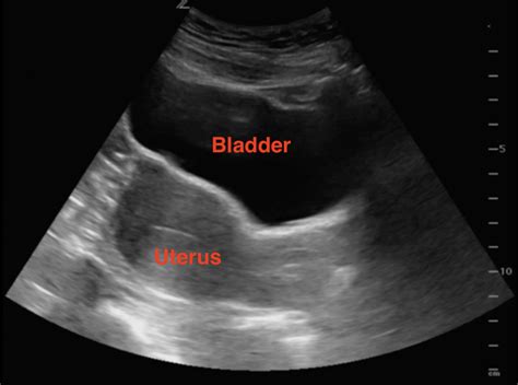 Early Pregnancy Ultrasound