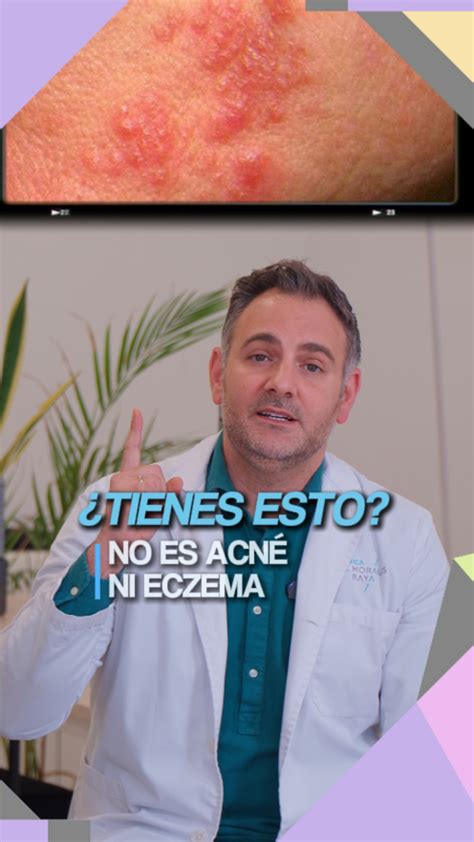 Eczema Que Es