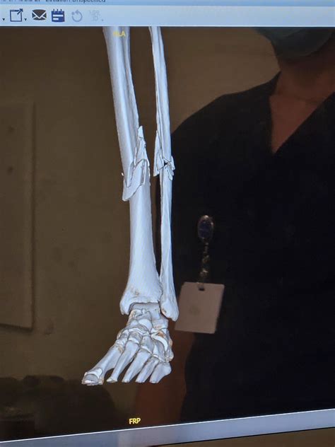 Tib and fib : r/XRayPorn
