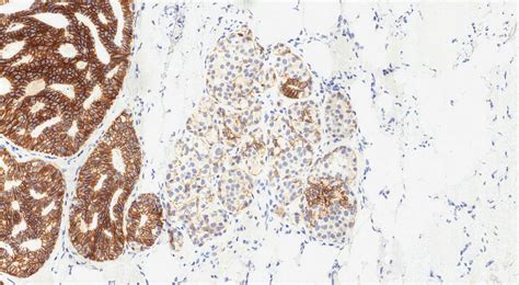 Your pathology report for atypical lobular hyperplasia of the breast | MyPathologyReport