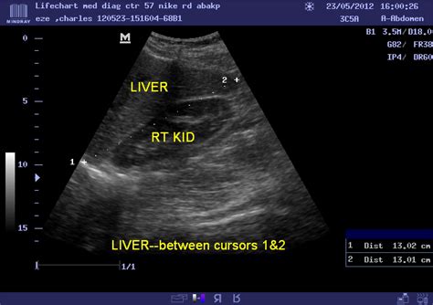 Child Liver Size Ultrasound at George Cho blog