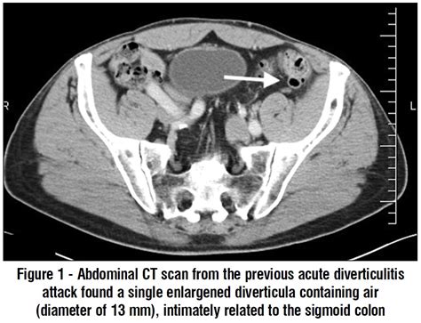 Image result for Colonic Diverticulum CT