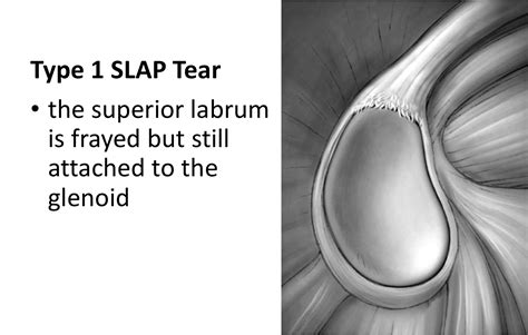 SLAP Tears – Cambridge Shoulder