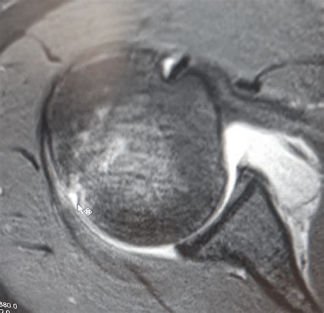 My Hill-Sachs lesion of Right Shoulder : r/Radiology