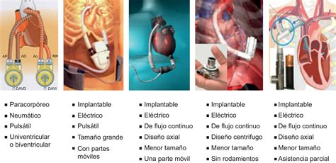 Asistencia ventricular mecánica » Mecanicos Valencia