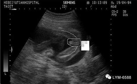 20140526懷孕14周稍微可以判斷出性別