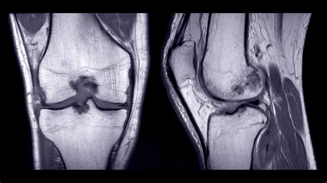 MRI for Knee Pain: When It’s Needed & What to Expect