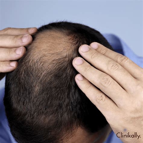 Redensyl vs Minoxidil for Hair Fall (Doctor's Guide) | Clinikally