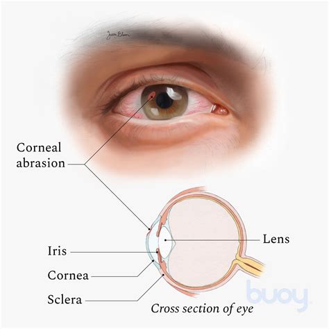 Eye Cornea Damage Symptoms - Infoupdate.org