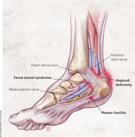 Plantar Fasciitis 的图像结果