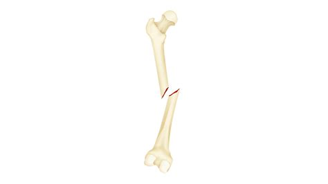Fracture Types | DePuy Synthes
