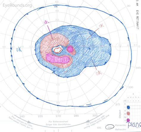 Bull's-eye maculopathy due to hydroxychloroquine toxicity