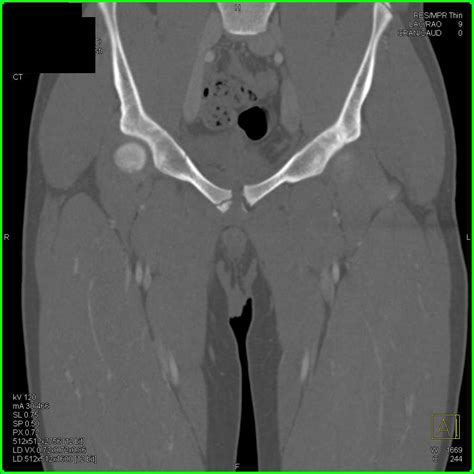 Fracture of the Right Superior and Inferior Pubic Ramus with Negative Angiogram ...