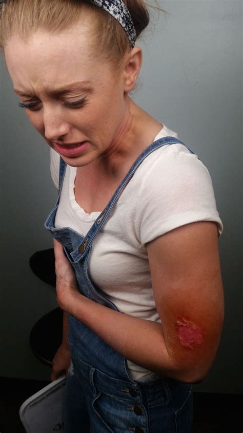 home treatment 2nd degree burn