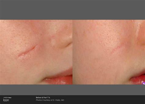 Scar Removal Treatments - Lindon UT