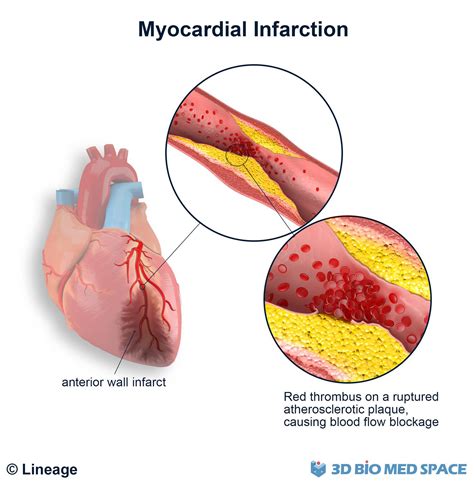 Anatomy Of Myocardial Infarction Type 2 Myocardial Infarction (MI)