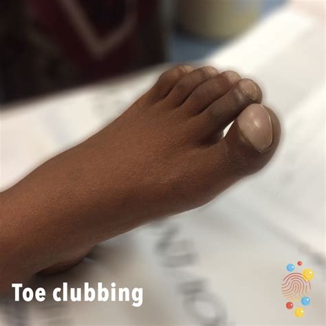 Top 100+ Pictures What Does Clubbing Of The Fingers Look Like Updated