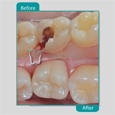 Types of Dental Crown Materials