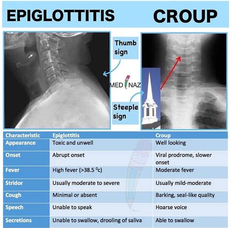 Thumbprint Sign Epiglottitis