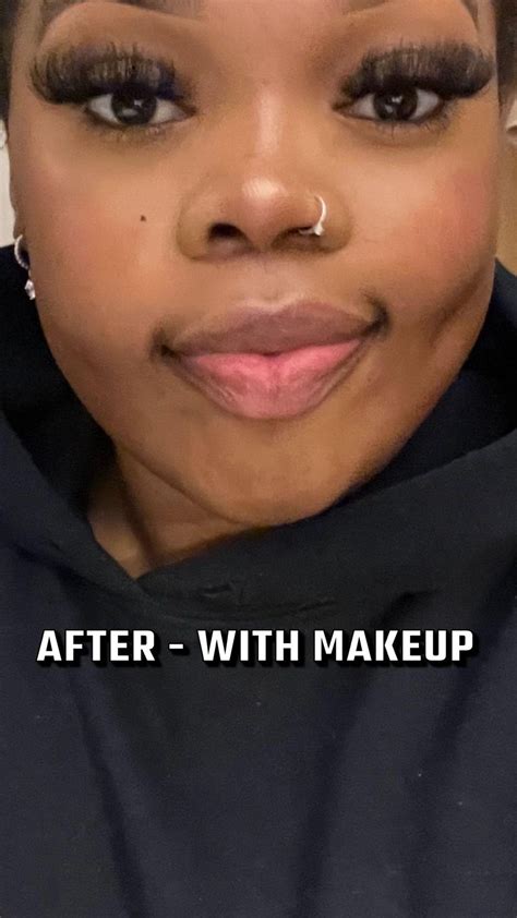 Jaw surgery ruined my face (before/after) : r/jawsurgery