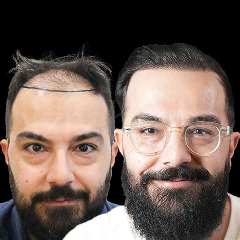 Comparing Hair Transplant Costs Worldwide | Bizrahmed