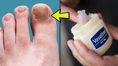 natural remedies nail fungus