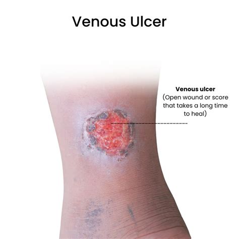 Venous Ulcers Treatments in Downtown Brooklyn