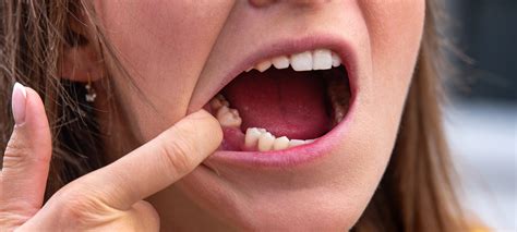 Tooth Socket After Extraction 的图像结果