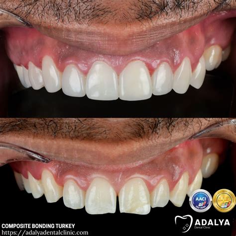 Composite Bonding Before and After - Adalya Dental Clinic