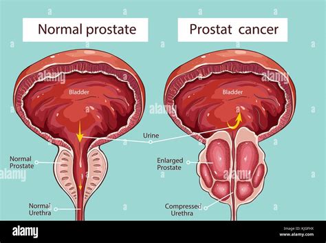 Image result for Normal Prostate Levels