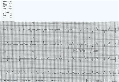 Peaked T waves | ECG Guru - Instructor Resources