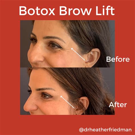 Brow Lift