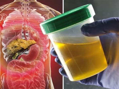 Liver Damage: మీ మూత్రం రంగులో ఈ మార్పు ఉంటే లివర్ డ్యామేజ్ అయినట్టే ...