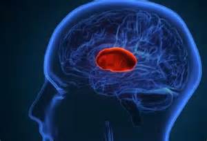 How long does a person survive after a brain hemorrhage? Know what to ...