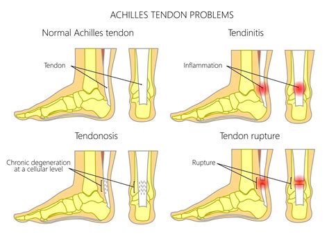 Image result for Running Extensor Tendonitis
