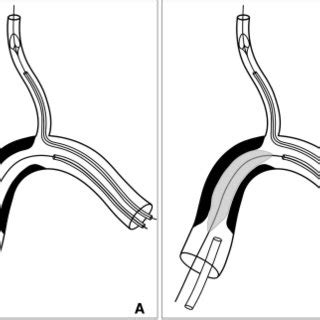 Image result for Wire Loc Procedure