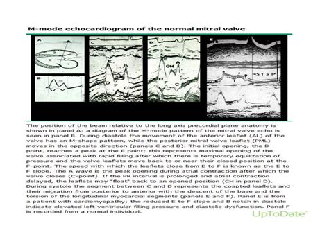 Mitral stenosis Echocardiography | PPT