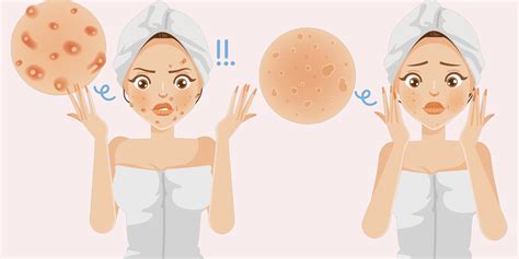 Acne Marks vs Acne Scars: Difference Between Acne Scars And Acne Marks ...