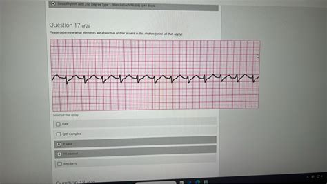 Sinus Rhythm with 2nd Degree Type 1 (Wenckebach/Mobitz I) AV Block Quest..